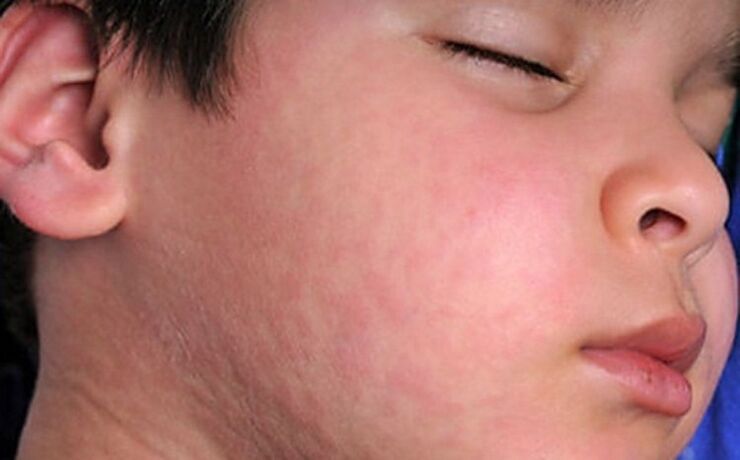 Ալերգիկ ցան մաշկի վրա՝ օրգանիզմում մակաբույծ որդերի առկայության ախտանիշ